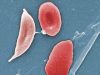 drepanocytose-696×392