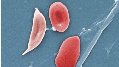 drepanocytose-696×392